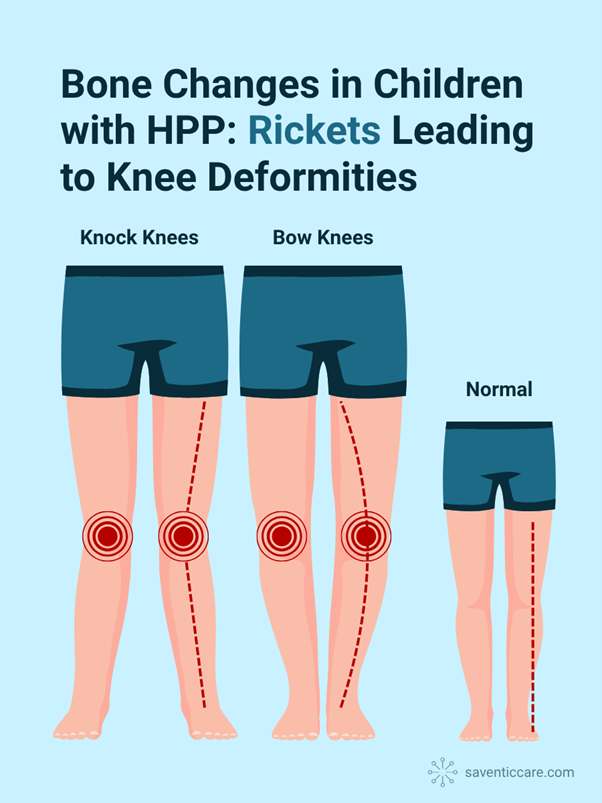 Illustration des genoux en coque, genoux en arc et jambes normales chez les enfants atteints d’hypophosphatasie (HPP) due au rachitisme.